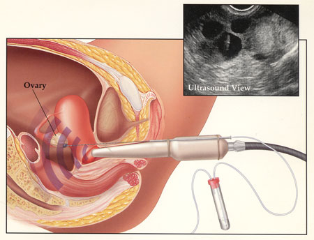 IVF